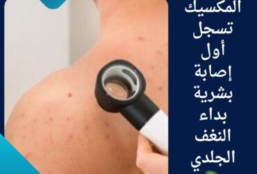 المكسيك تسجل أول إصابة بشرية بداء النغف الجلدي 🦠